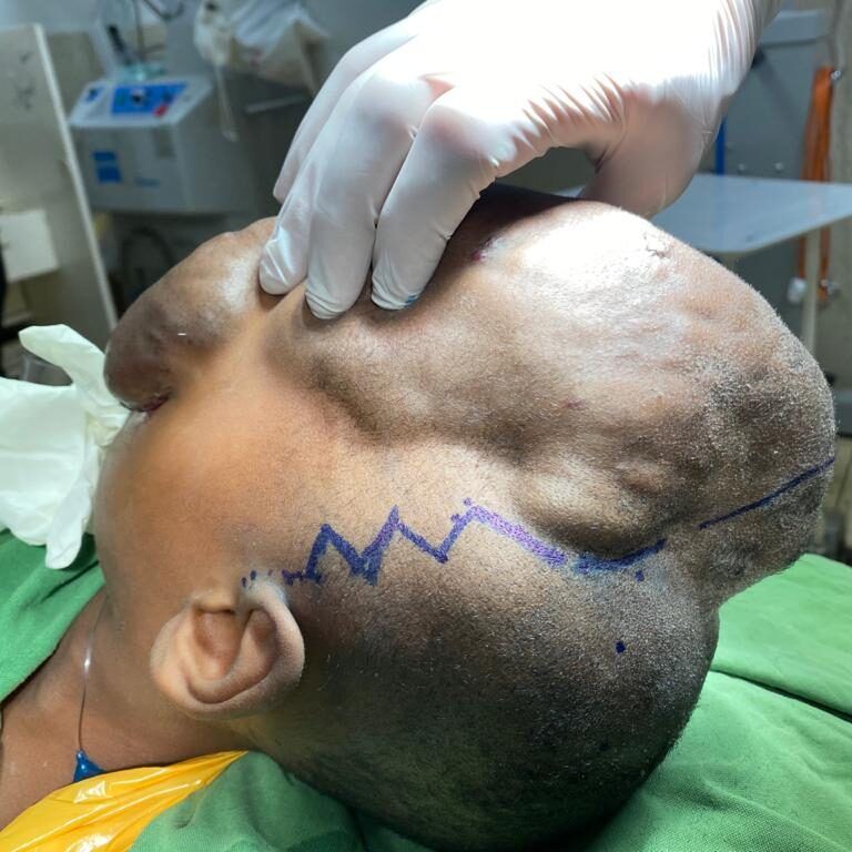 During-Surgery_2